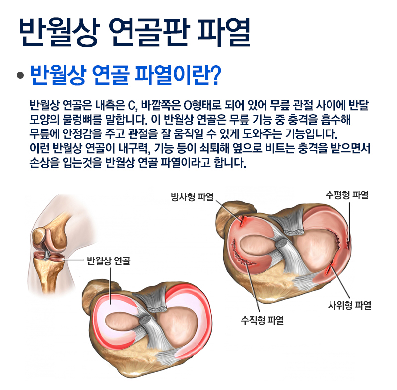 무릎통증 반월상 연골 파열-광주새나래병원